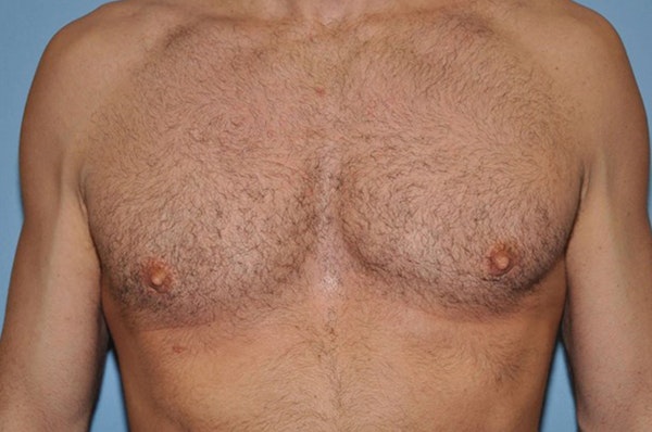 Gynecomastia Before & After Gallery - Patient 6389431 - Image 2
