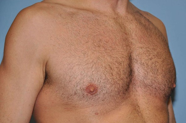 Gynecomastia Before & After Gallery - Patient 6389431 - Image 4