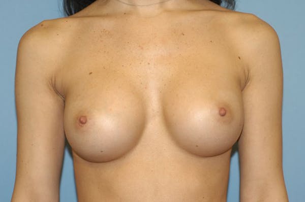 Breast Augmentation  Gallery - Patient 9568358 - Image 2