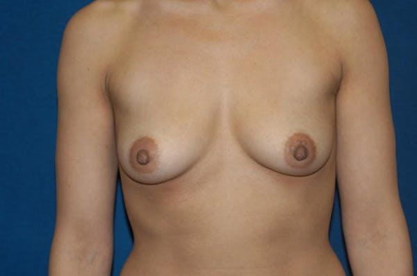 Breast Augmentation  Gallery - Patient 9568364 - Image 1