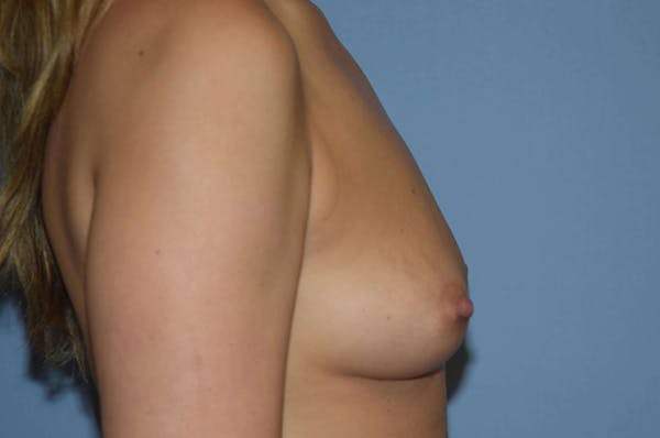 Breast Augmentation  Gallery - Patient 9568488 - Image 5