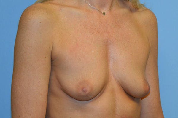 Breast Augmentation  Before & After Gallery - Patient 9582099 - Image 3