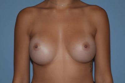 Breast Augmentation  Gallery - Patient 9582102 - Image 2
