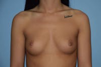 Breast Augmentation  Gallery - Patient 9582108 - Image 1