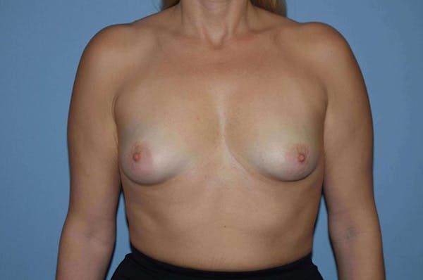Breast Augmentation  Before & After Gallery - Patient 9582140 - Image 1