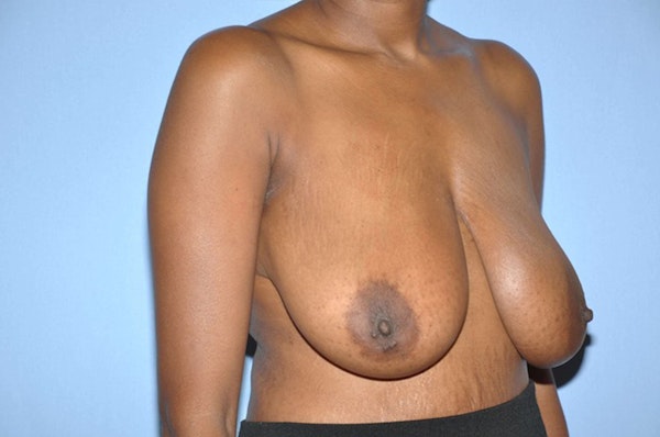 Breast Reduction Before & After Gallery - Patient 6389835 - Image 3