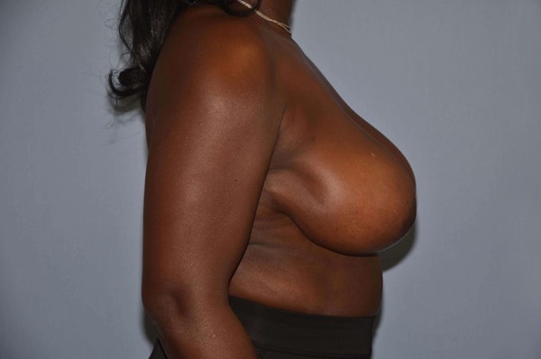 Breast Reduction Before & After Gallery - Patient 6389837 - Image 4