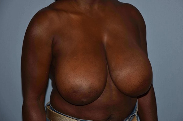 Breast Reduction Before & After Gallery - Patient 6389837 - Image 5