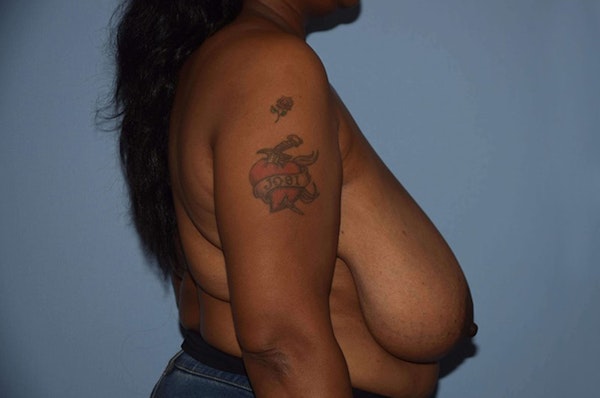 Breast Reduction Before & After Gallery - Patient 9568215 - Image 5