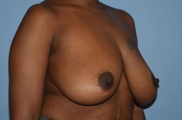 Breast Reduction Before & After Gallery - Patient 9568217 - Image 3