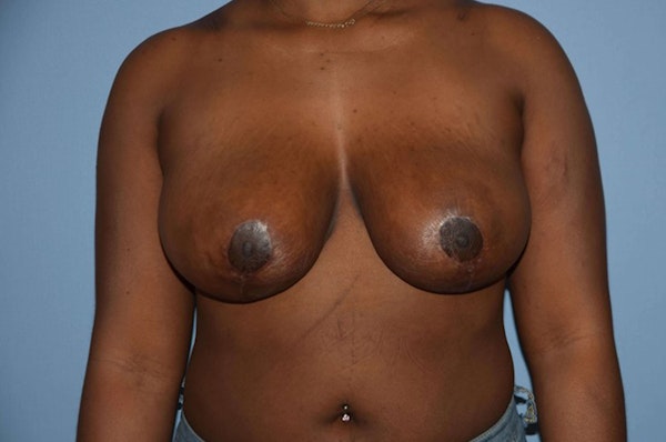 Breast Reduction Before & After Gallery - Patient 9568238 - Image 2
