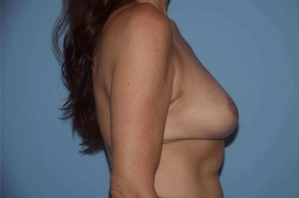 Breast Reduction Before & After Gallery - Patient 9568281 - Image 4