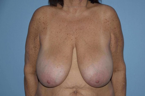 Breast Reduction Before & After Gallery - Patient 9568294 - Image 1