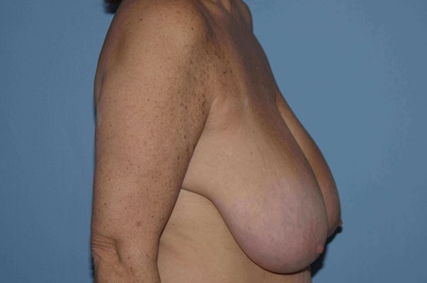 Breast Reduction Before & After Gallery - Patient 9568294 - Image 5