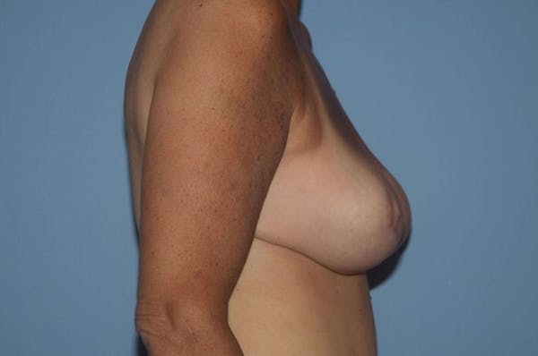 Breast Reduction Gallery - Patient 9568294 - Image 6