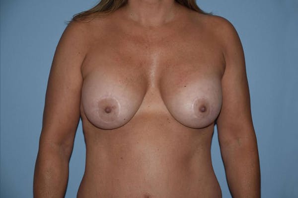 Breast Augmentation Lift Gallery - Patient 6389852 - Image 2