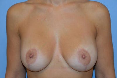 Breast Augmentation Lift Before & After Gallery - Patient 6389868 - Image 2