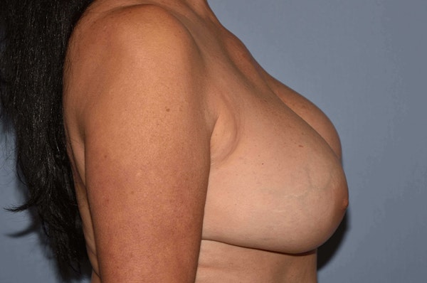 Breast Augmentation Lift Before & After Gallery - Patient 9567920 - Image 5