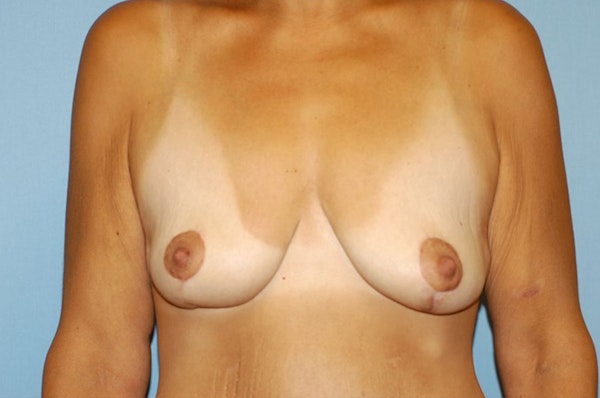 Breast Lift Before & After Gallery - Patient 6389711 - Image 2