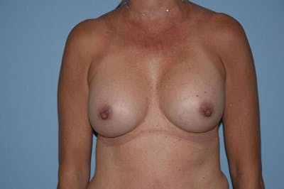 Breast Revision Before & After Gallery - Patient 6389737 - Image 2