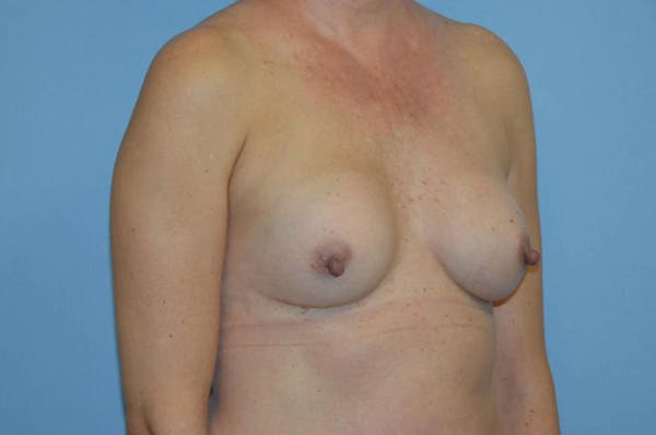 Breast Revision Gallery - Patient 6389737 - Image 3