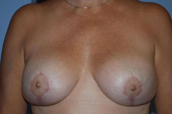 Breast Revision Gallery - Patient 6389743 - Image 2