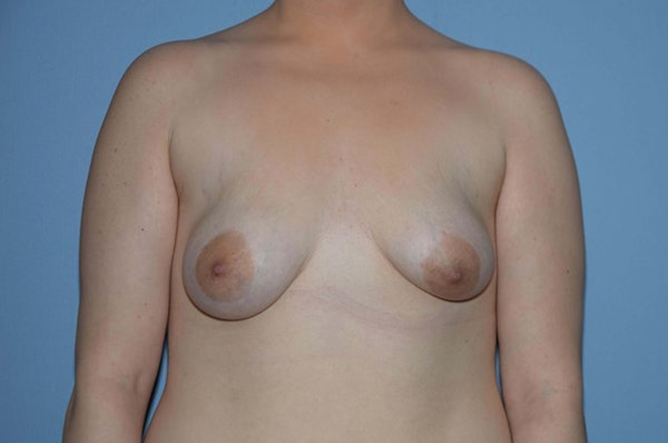 Breast Asymmetry Before & After Gallery - Patient 6389695 - Image 1
