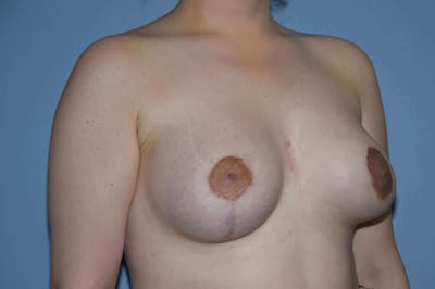 Breast Asymmetry Before & After Gallery - Patient 6389695 - Image 4