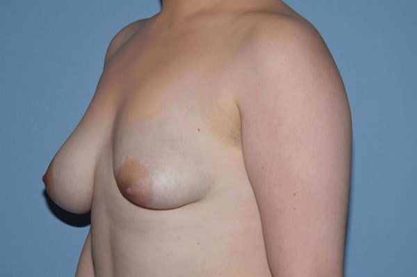 Breast Asymmetry Before & After Gallery - Patient 6389695 - Image 5