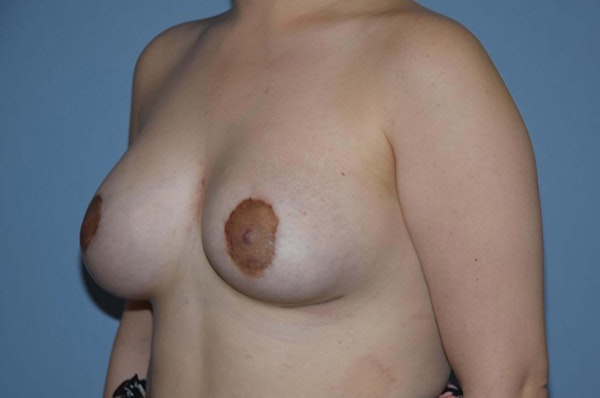 Breast Asymmetry Before & After Gallery - Patient 6389695 - Image 6