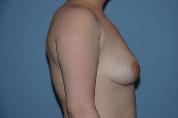 Breast Asymmetry Before & After Gallery - Patient 6389695 - Image 7