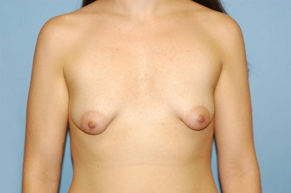 Breast Asymmetry Gallery - Patient 6389699 - Image 1