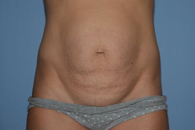 Tummy Tuck Before & After Gallery - Patient 25277481 - Image 1