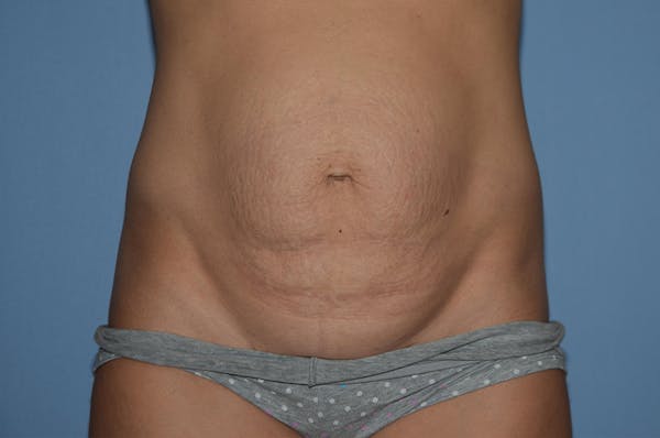 Tummy Tuck Gallery - Patient 25277481 - Image 1