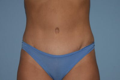 Tummy Tuck Before & After Gallery - Patient 25277481 - Image 2