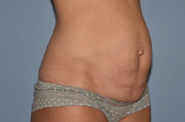 Tummy Tuck Before & After Gallery - Patient 25277481 - Image 3