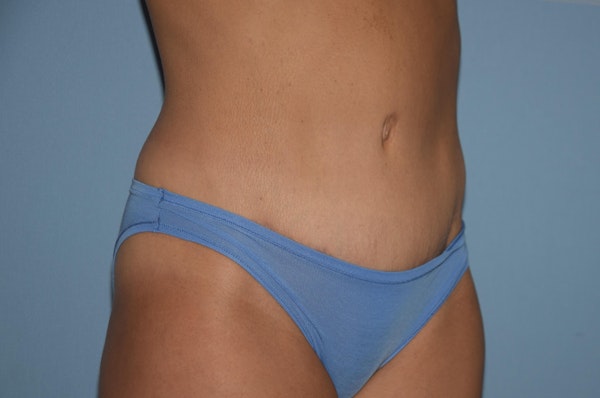 Tummy Tuck Before & After Gallery - Patient 25277481 - Image 4