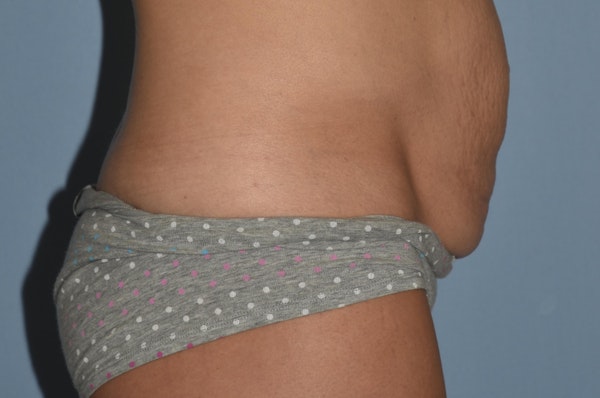 Tummy Tuck Before & After Gallery - Patient 25277481 - Image 5