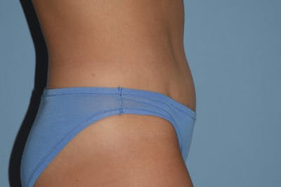 Tummy Tuck Before & After Gallery - Patient 25277481 - Image 6