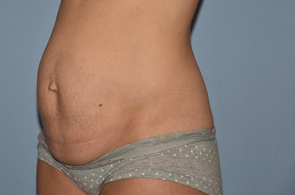 Tummy Tuck Before & After Gallery - Patient 25277481 - Image 7