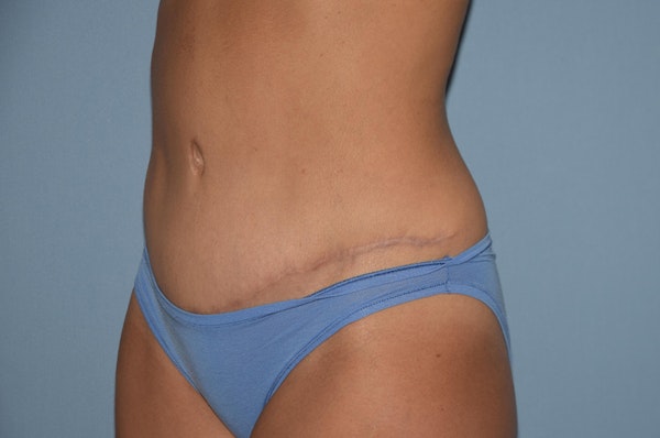 Tummy Tuck Before & After Gallery - Patient 25277481 - Image 8