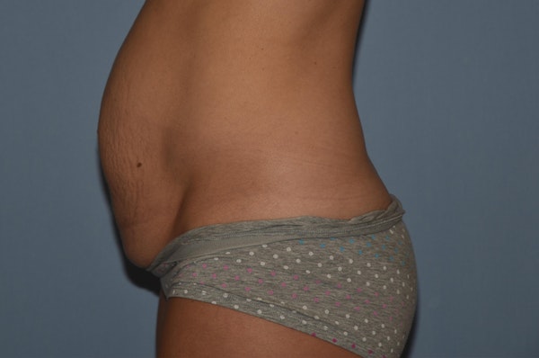 Tummy Tuck Before & After Gallery - Patient 25277481 - Image 9