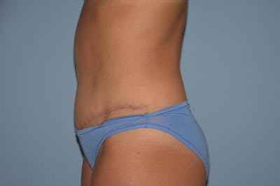 Tummy Tuck Before & After Gallery - Patient 25277481 - Image 10