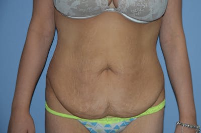 Tummy Tuck Before & After Gallery - Patient 25279719 - Image 1
