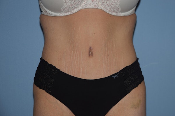 Tummy Tuck Before & After Gallery - Patient 25279719 - Image 2