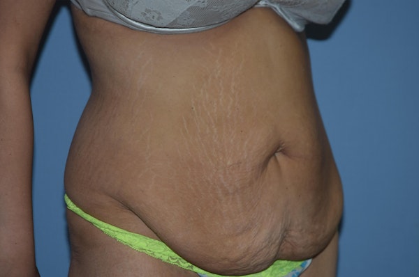 Tummy Tuck Before & After Gallery - Patient 25279719 - Image 3