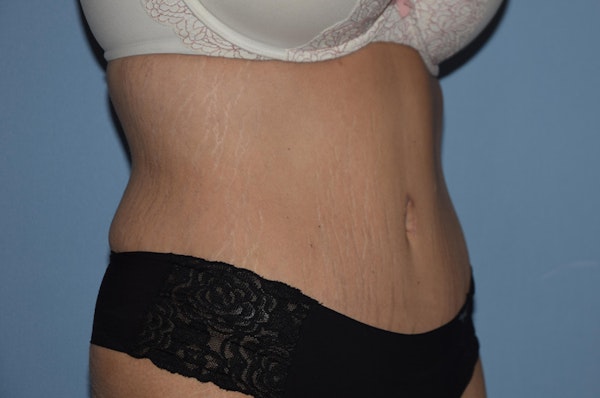 Tummy Tuck Before & After Gallery - Patient 25279719 - Image 4