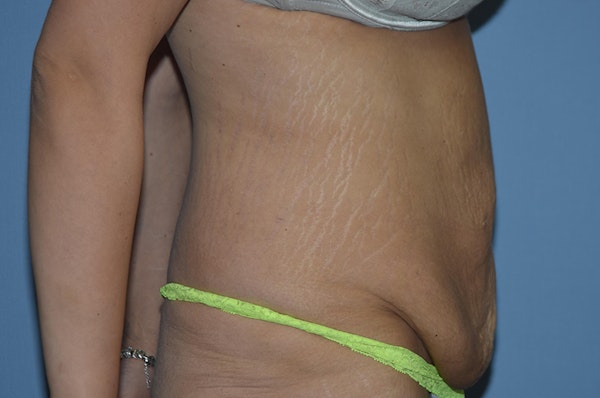 Tummy Tuck Before & After Gallery - Patient 25279719 - Image 5