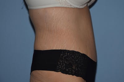 Tummy Tuck Before & After Gallery - Patient 25279719 - Image 6
