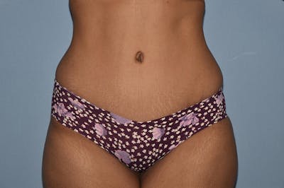Tummy Tuck Before & After Gallery - Patient 25279738 - Image 2